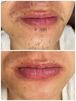 ダブルオー 銀座(00)/美容電気脱毛/ヒゲ脱毛/髭脱毛