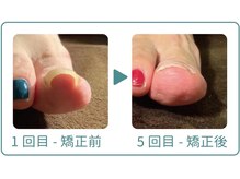 巻き爪研究所 表参道院/ネイルをしていた人も効果あり