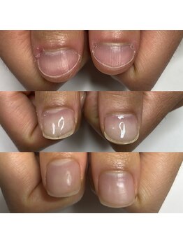 マニュコクーン(ManuCocoon)/爪育成 深爪 巻き爪 大阪市