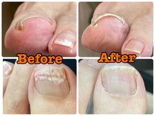 町田市巻き爪センター/キレイに整いました！