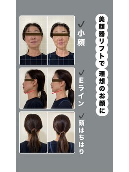 シャンタイン(SANTAI)/瞬間小顔が叶う★美顔器リフト