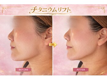 キャンディ 海老名駅前店(Candy)/チタニウムリフト/フェイシャル