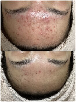 ザ フェース 東京目黒店(THE FAITH)/ニキビケア