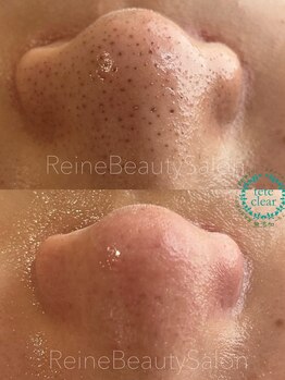 レーヌ(Reine)/毛穴エクストラクション