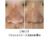 【プロセルフェイシャル】毛穴＆ニキビケア　初回41000円(アフター美容液込み