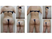 ハッピーハンド(HAPPY HAND)/新型サーモシェイプOpus導入！