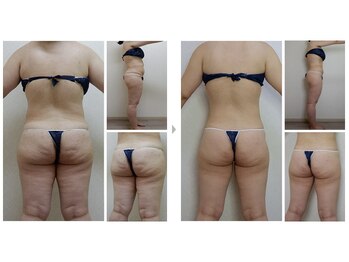 ハッピーハンド(HAPPY HAND)/新型サーモシェイプOpus導入！