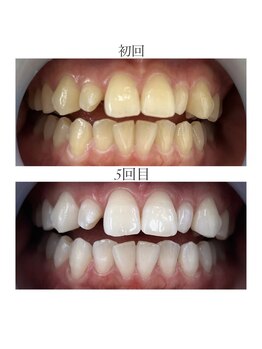 ホワイトニングショップ 静岡店/ホワイトニングBefore→After