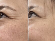 ブルーム(BLOOM)/最先端エステ機器　WISH PRO