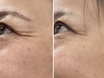 ブルーム(BLOOM)/最先端エステ機器　WISH PRO