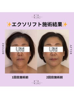 アルティ バイ ドルチェ(Ulti by dolce)/専門機関監修エクソリフト結果