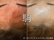 コマ(KOMA)