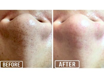 毛穴屋/メンズの毛穴悩みにも◎