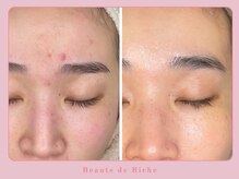 ボーテドリッシュ(Beaute de Riche)/ニキビケアbeforeafter