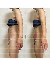 リノリー(rinory)/脂肪冷却