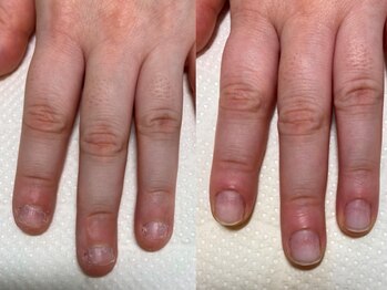 シャルム ド ネイルズ(Charm de nails)の写真/深爪/爪が弱い・小さい/かみ癖/むしり癖/男爪などでお悩みの方に！爪のトラブルはお任せください★