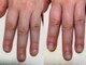 シャルム ド ネイルズ(Charm de nails)の写真/深爪/爪が弱い・小さい/かみ癖/むしり癖/男爪などでお悩みの方に！爪のトラブルはお任せください★