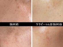 ベリッセ(Belisse)/ララピール４回