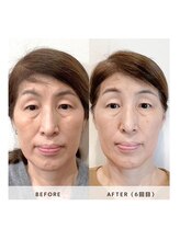 サロン レインボー(SALON RAINBOW)/小顔集中コース　Before/After