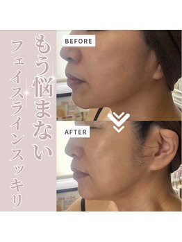 リラクゼーションサロン ラキ(laki)/ハイピールイントゥ/ピーリング