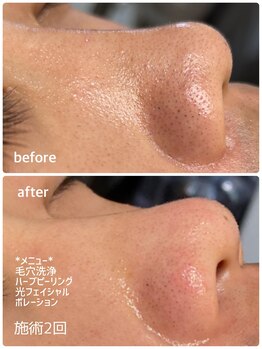 ラエッセ 恵比寿(LAESSE)/【毛穴洗浄】いちご鼻卒業！