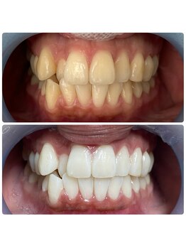 エンコロレ(encolore)/《クリスタルホワイトニング》