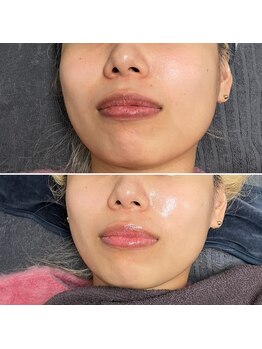 スリーアイ 天王寺店(3EYE)/エクソソーム導入で水光肌へ