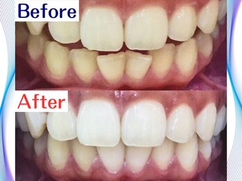 LBSホワイトニング 新宿店/ホワイトニングビフォーアフター