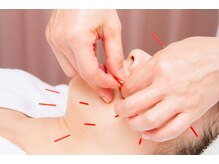 シンリュウ(SHIN-RYU)/【美容鍼】