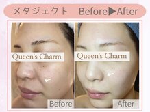 クイーンズチャーム(Queen's Charm)/メタジェクトフェイシャル