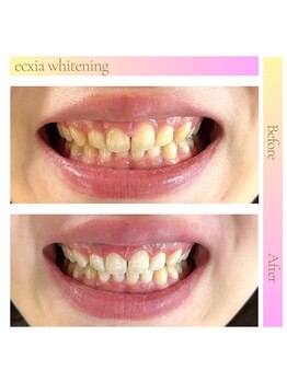 エクシアホワイト 平岸駅前店/ホワイトニングビフォーアフター