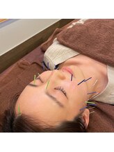 長寿鍼灸院 長寿整骨院/美容鍼25本の効果★肌質改善