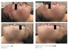 【ニキビケア】アクネ菌撃退&角質ケアでニキビ肌卒業コース