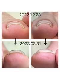 お爪の巻きによる痛みからの解放