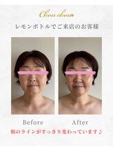 シュシュ(Chouchou)/レモンボトル1回