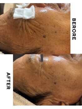 ゼロ 水戸店(ZERO)/シミ・シワ肌質改善スペシャル