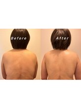 モア(MOA)/背中から首肩までスッキリ！