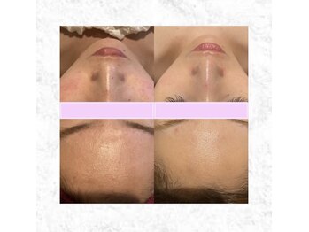 ビューティーマックス エースタジオ(Beauty MAX Astudio)/エンビロン　カウンセリング