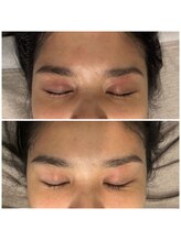 モンド 駒込店(monde)/ハーブピーリング