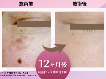 花蔵 浦和コルソ店/【コース開始12か月経過時点】