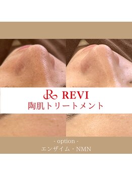 ルナージュ(LUNARJE)/陶肌トリートメント