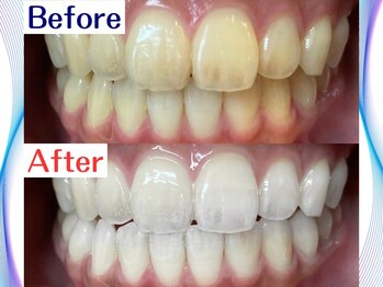 LBSホワイトニング 新宿店/ホワイトニングビフォーアフター