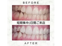 エミリアホワイトニング(EMIRIA WHITENING)/Before/After