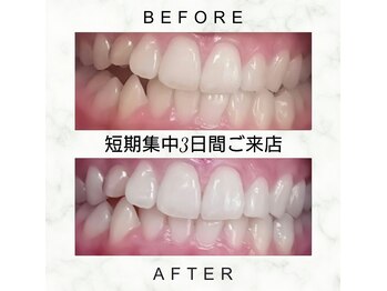 エミリアホワイトニング(EMIRIA WHITENING)/Before/After