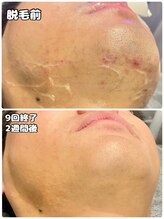 ワイズサロン(Y's salon)/ヒゲ脱毛9回終了別アングル