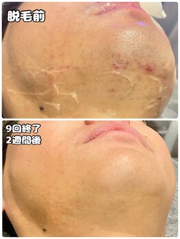 ワイズサロン(Y's salon)/ヒゲ脱毛9回終了別アングル