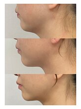 《韓国美容専門店》BELL BEAUTY SALON &nbsp;&nbsp;小顔/毛穴洗浄/シミ/痩身&nbsp;韓国式小顔 #二重あご