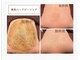 ミヤビサロン 新宿店(Miyabiサロン)の写真/陶肌トリートメント 背中ケア