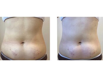 エイシスグロウ(asis glow.)/効果写真