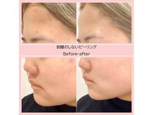 ディアメ(Diame)/ピーリングでニキビケア☆